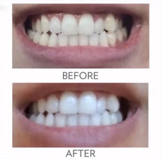 whitening_toothpaste_before_ after